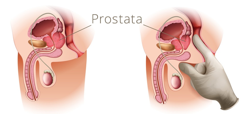 Tastuntersuchung - Prostata – Medeno Medical Check-Up – Bremen